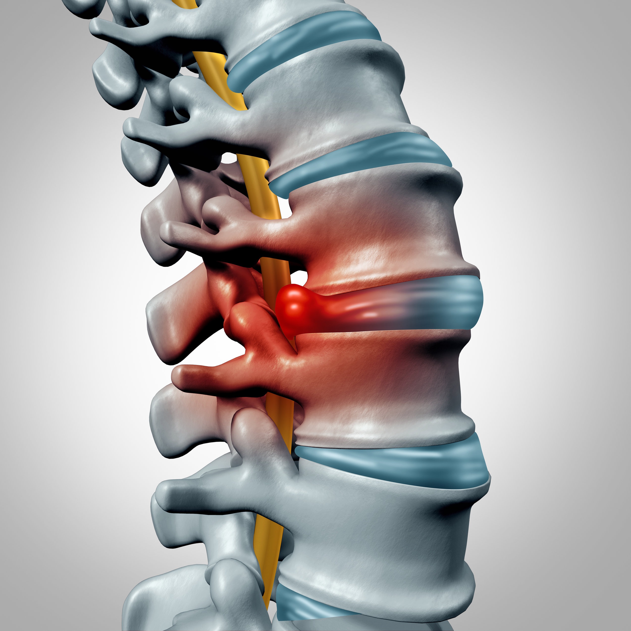 Spinal Decompression - Innovative technology to alleviate disc and back pain